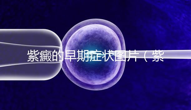 紫癜的早期癥狀圖片(紫癜是小病還是大病)