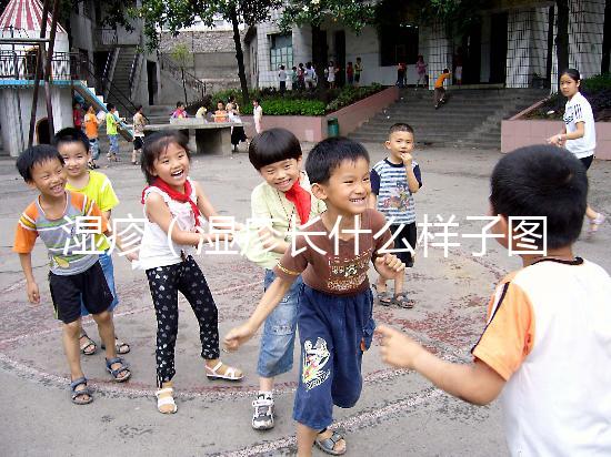 濕疹（濕疹長(zhǎng)什么樣子圖片）